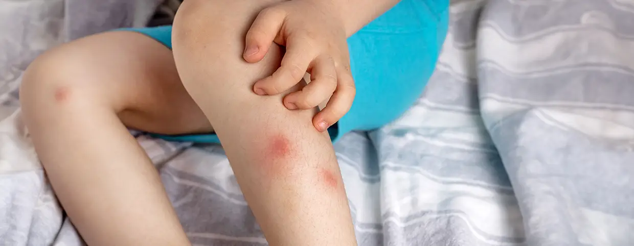 Mosquito bite rashes on child’s leg